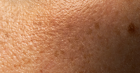 Dull skin