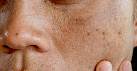 Dark spots
