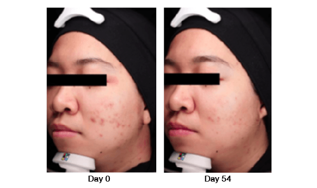 `เซรั่มลดสิว รอยสิว`
Bioactive Acne Clear Serum ยืนยันผลลัพธ์ด้วยผู้ใช้จริง