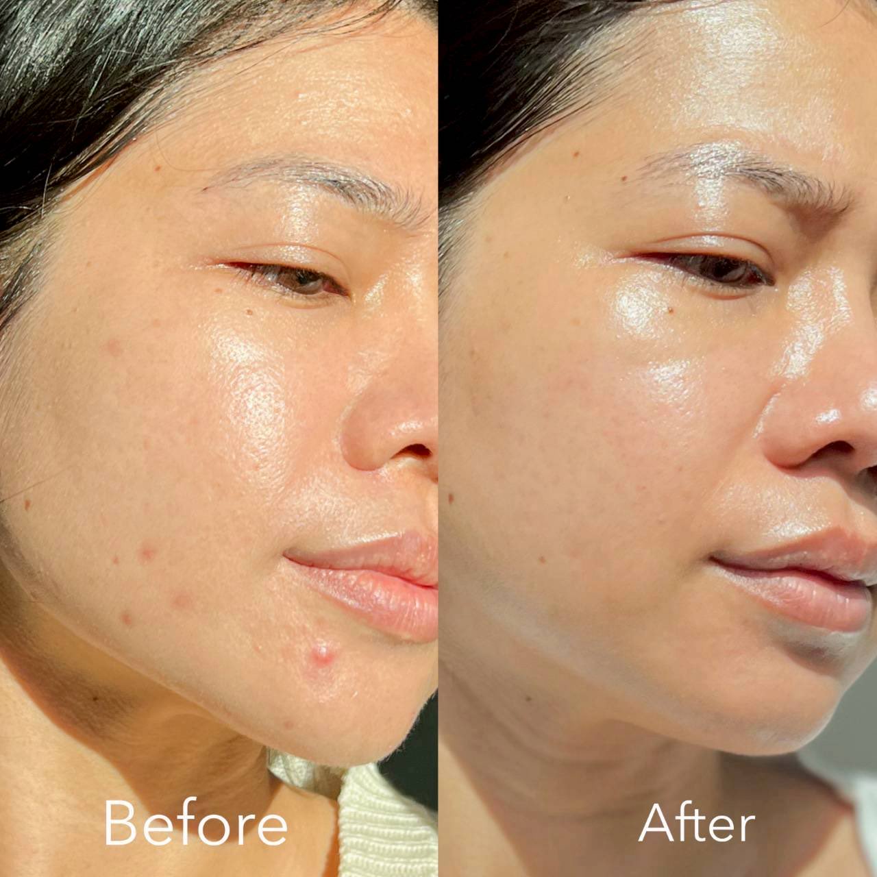 คนเป็นสิวอักเสบ สิวซ้ำซากเธอไม่ต้องนอย!! ไปลอง วิตามินสวบสิวPearletane ของ Nectapharma คะแนนเต็ม 10 ฉันให้ 100 พวกสิวฮอร์โมนก็ดีขึ้นด้วย เขาเลือกใช้ Zinc จาก Albion Mineral เป็นฟอร์มที่ดูดซึมดีกว่า Zinc ทั่วไป แล้วมีงานวิจัยรองรับเยอะมากกก กินแค่วันละ 2 เม็ดหลังอาหาร ช่วยคุมมัน ลดการอักเสบของสิว ดีมากกกก