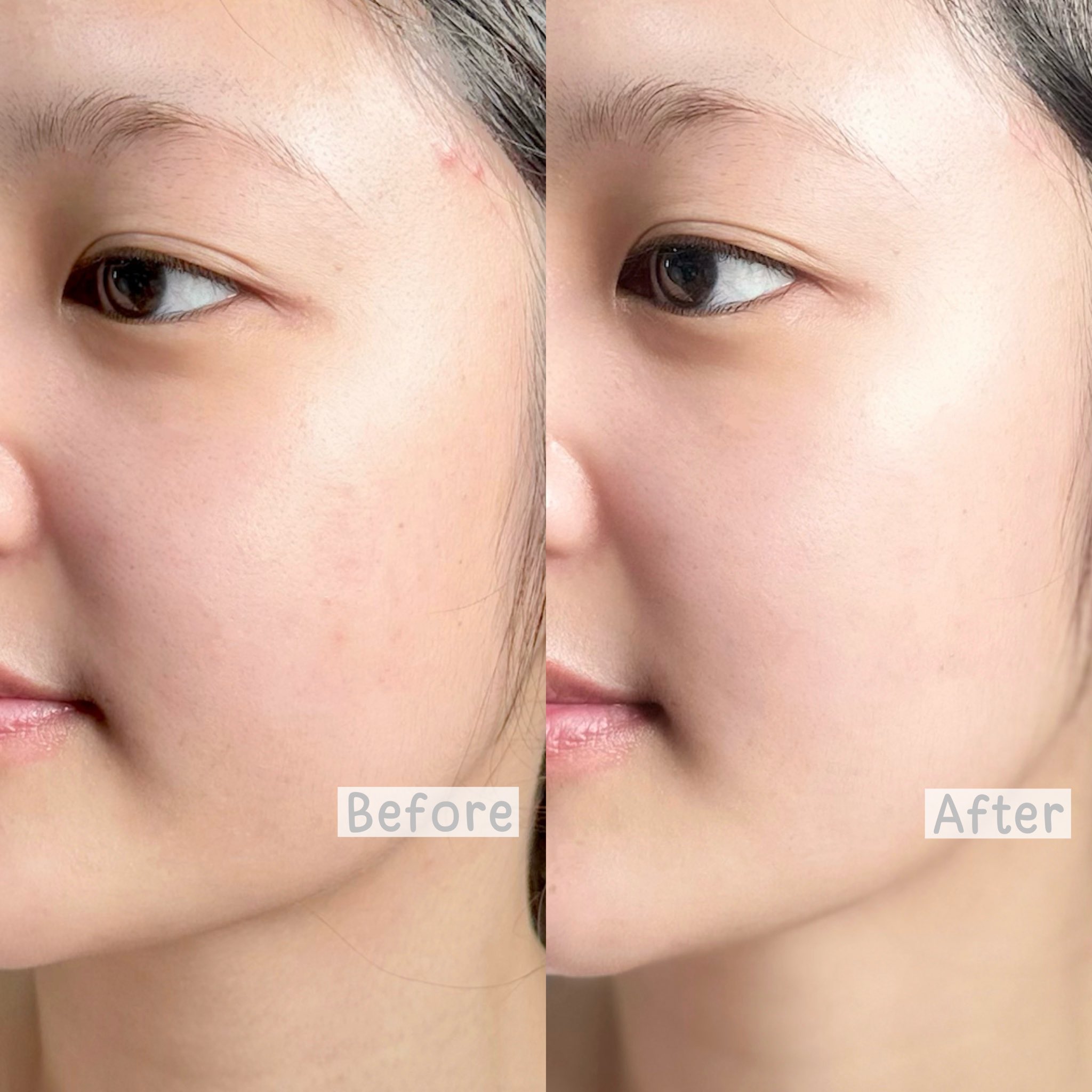 วิตามินสวบสิว Pearletane ของ Nectapharma คือตัวนึงที่ยังกินอยู่ตลอด เพราะดีมากกก เพราะนี่ช่วงเป็นประจำเดือนสิวชอบขึ้นแล้วทิ้งรอยสิวไว้ตลอด แล้วส่วนตัวรู้สึกว่าสิวอักเสบค่อยๆยุบ สิวแห้งไวขึ้น รู้สึกว่าผิวหน้าดีขึ้นมากจริงๆ แล้วที่ชอบอีกอย่างคือชีช่วยเรื่องลดรอยสิวดีมากๆ ถูกใจคนมีรอยสิวสุดๆ แล้วช่วยเรื่องควบคุมความส่วนเกินด้วย นี่ว่าหน้ามันน้อยลง แต่ไม่ได้ทำให้หน้าแห้งเหมือนกินยารักษาสิวนะ ผิวดูแข็งแรงขึ้น สิวขึ้นซ้ำจุดเดิมน้อยลง เป็นวิตามินที่ชอบมากกก