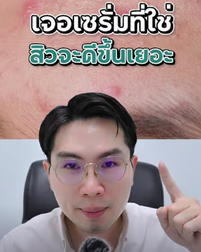 ส่วนผสมที่ใช่ สำหรับคนเป็นสิว