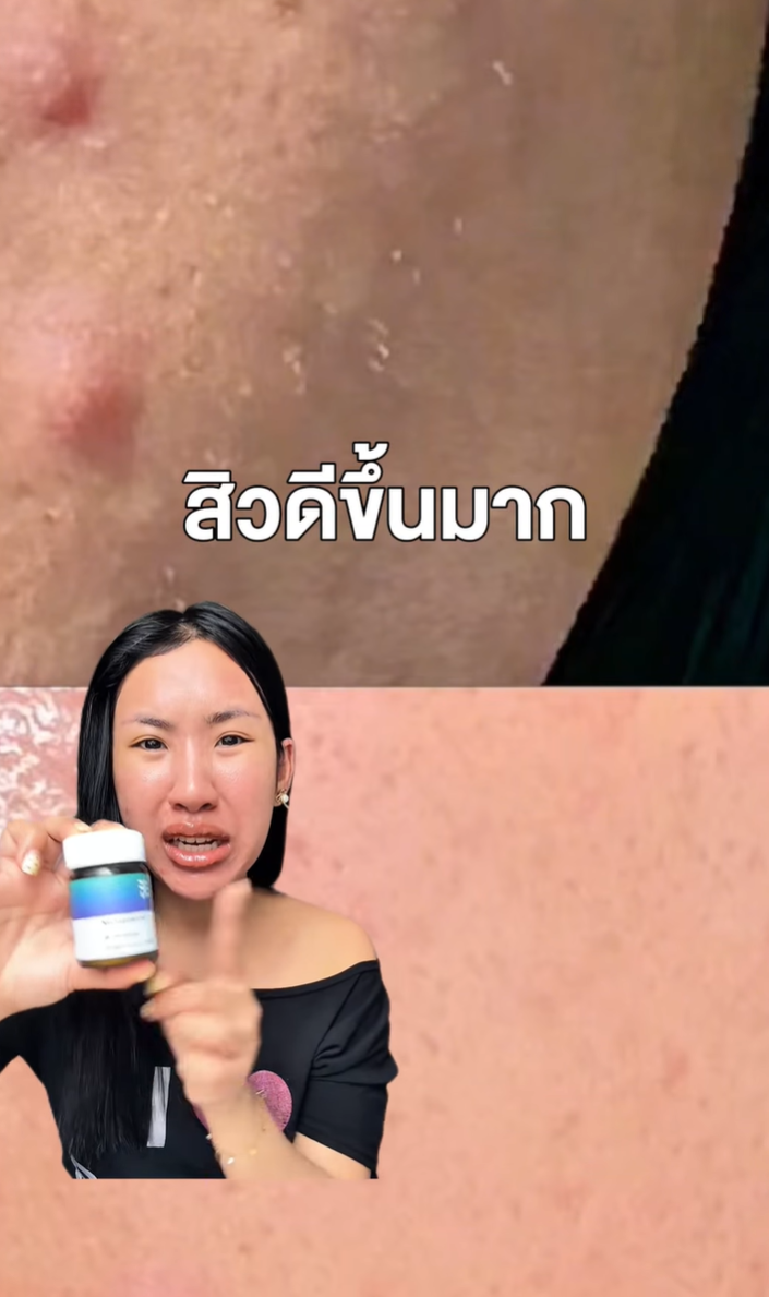 คิดมาให้แล้ว! เหมาะกับคนเป็นสิว ผิวมัน 👀
เพราะลองเองจริงๆถึงกล้าบอกต่อ✨

ตัวนี้ช่วยจัดการตั้งแต่ต้นตอ ลดความมัน เชื้อสิว
ผิวไม่แห้ง ใครเจ็บมาเยอะอยากให้ลองตัวนี้ 👀