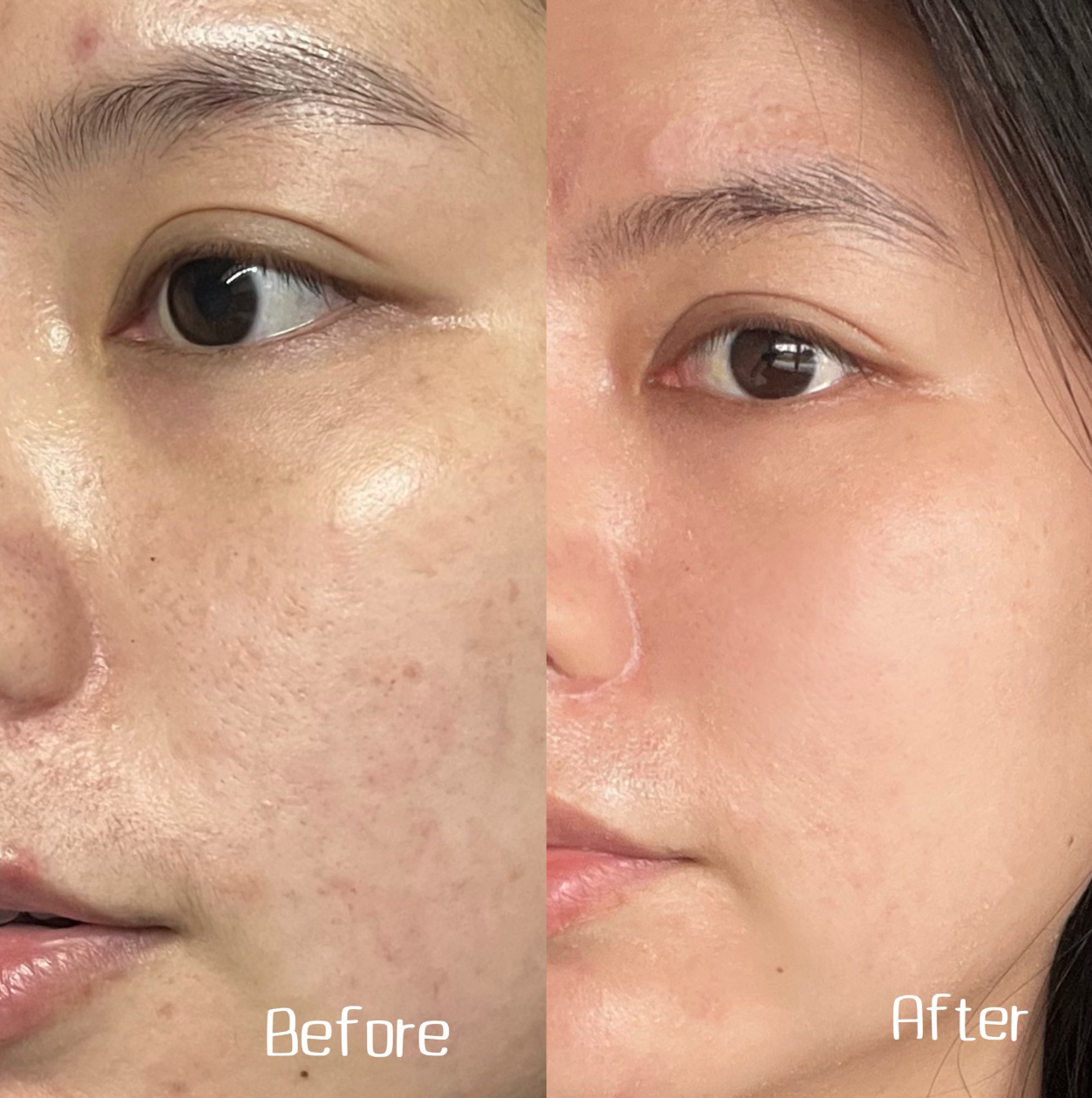 อันนี้คือผิวแบบไม่เข้าคลินิก ไม่เคยเลเซอร์ ใช้แค่ Retinol ตัวเดียวจริง ๆ  ชอบมากอยากป้ายยาเราแนะนำ ตึงนอลเซรั่มของ Nectapharma เป็น 0.1% Retinol ที่เห็นผลดีกว่า 0.5% Retinol เพราะตัวนี้เขาเสริมบูสเตอร์มาอีก 2 ชนิด เลยได้ประสิทธิภาพที่แรงแต่อ่อนโยนมาก ๆ แบบรู้สึกได้เลย ใช้แล้วหน้าไม่แห้งลอก ไม่แสบแดงเลย แล้วคือแบรนด์เขาบอกว่าช่วยจัดการซอมบี้เซลล์ตัวการผิวแก่ได้ด้วย เราใช้แค่เม็ดถั่วทุกวันก่อนนอน ทุกวันนี้ชอบผิวตัวเองหลังแต่งหน้ามาก ผิวละเอียดนุ่มเด้ง พวกริ้วรอยจางลงจริง ไปลองกันทุกคน