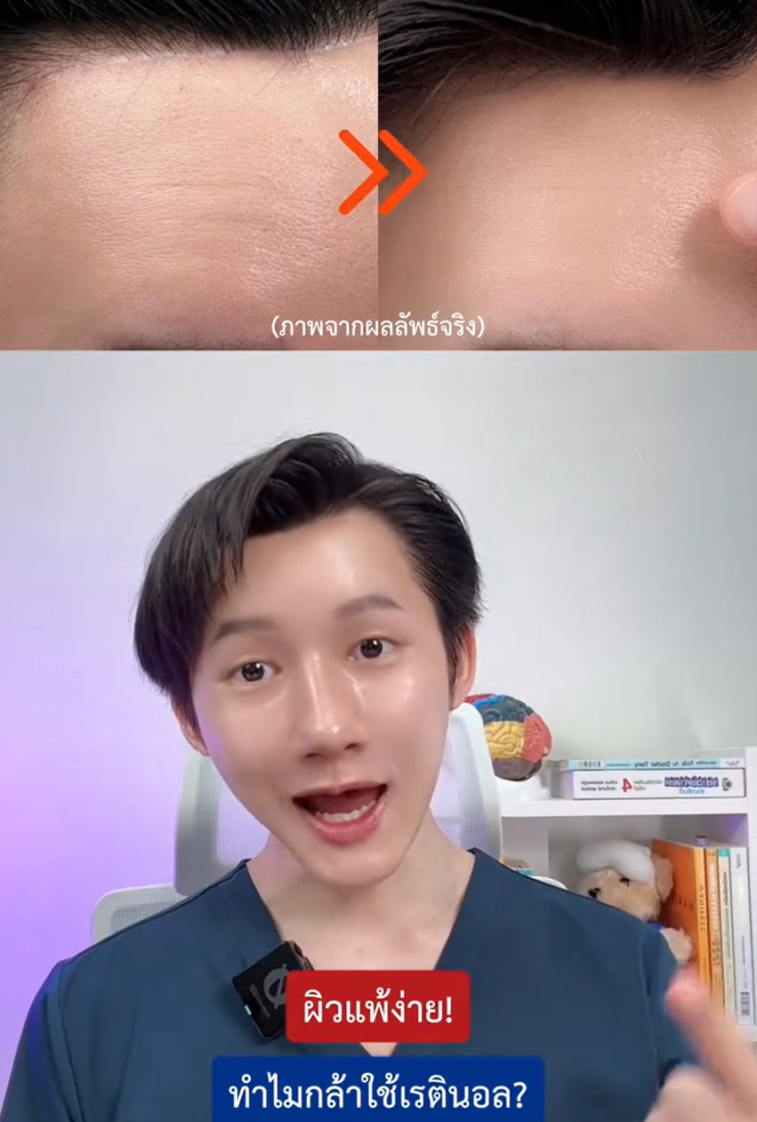 ส่วนผสมดี เปอร์เซ็นต์ให้ครบ #DualBoosterRetinolSerum #ตึงนอลเซรั่ม #Nectapharma #เนคตาฟาร์มา
ประโยชน์ของตึงนอลเซรั่มกับเรตินอล
ค้นพบประโยชน์ของตึงนอลเซรั่มและเรตินอลในการดูแลผิว พร้อมเคล็ดลับการใช้! #DualBoosterRetinolSerum #เนคตาฟาร์มา