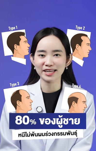 80% ของผู้ชายมักเจอปัญหาผมร่วงกรรมพันธุ์
แล้วลักษณะของผมร่วงกรรมพันธุ์เป็นยังไง เช็กได้ในคลิปนี้ ✨