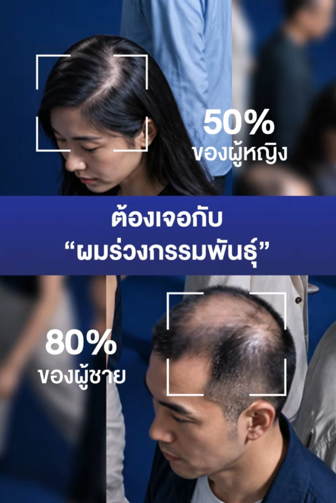 ผมร่วงกรรมพันธุ์…แก้ได้!

⭐️ Revitafol #วิตามินแฮร์เกิดสูตรใหม่ จัดการต้นเหตุผมร่วงกรรมพันธุ์

✅ ACTRISAVE™ ลดฮอร์โมน DHT สาเหตุหลักผมร่วงกรรมพันธุ์และฟื้นฟูรากผม
✅ AnaGain™ Nu ช่วยผมงอกใหม่ระดับยีน
✅ สารสกัด อีก 13 ชนิด ช่วยดูแลผมร่วงอย่างครอบคลุม
.
🔬งานวิจัยพบว่า ACTRISAVE™ ช่วยให้สัดส่วนผมระยะงอกต่อระยะหลุดร่วงดีขึ้น 45.7% ใน 3 เดือน
.
ซื้อได้แล้ววันนี้