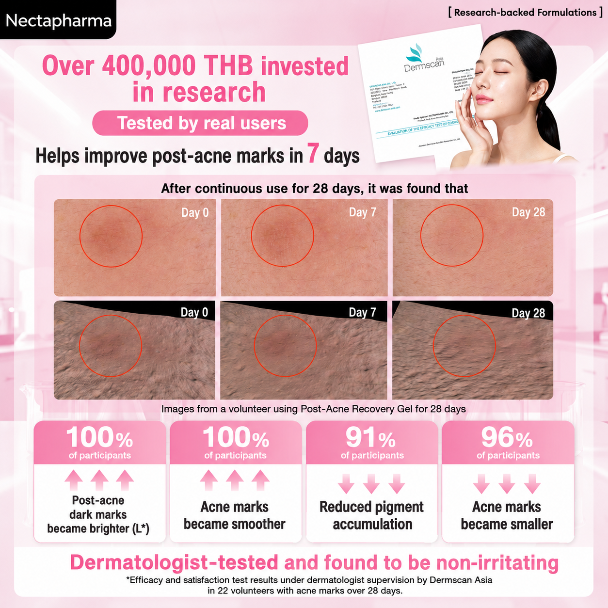 `Importance of acne scar gels and acne mark gels after inflammatory acne.`
