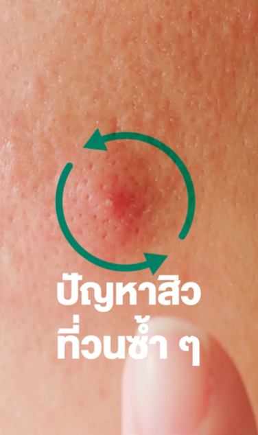 nectapharma
 
2 วัน
Biofilm หนึ่งในปัจจัยที่ทำให้ปัญหาสิวมูฟออนเป็นวงกลมมาเป็นที่จุดเดิม 👀

✨SOS Acne Spot Gel เจลซ่อมสิว
จัดการสิวอักเสบเเบบตรงจุด มาพร้อมกับ 6.67% SalSphere® Even Skin เทคโนโลยี Smart Release Encapsulation ที่ค่อย ๆ ปลดปล่อยสารสำคัญเฉพาะบริเวณที่มีปัญหา ช่วยลดการรบกวนผิวโดยรอบ ซึ่งต่างจาก Salicylic Acid ทั่วไป

เสริมด้วยสารสกัดอีก 3 ชนิด
✅ 3% WKPep® Anti-Acne Peptide
✅1% EQUIBIOME™
✅ 3% Allium Cepa Extract

ผ่านการทดสอบในคนจริง โดยแพทย์ผิวหนังสถาบันวิจัย Dermscan Asia

เจลแต้มสำหรับผู้มีปัญหาสิวอักเสบ ไอเทมสิวบุกต้องมีตัวช่วยด่วน!