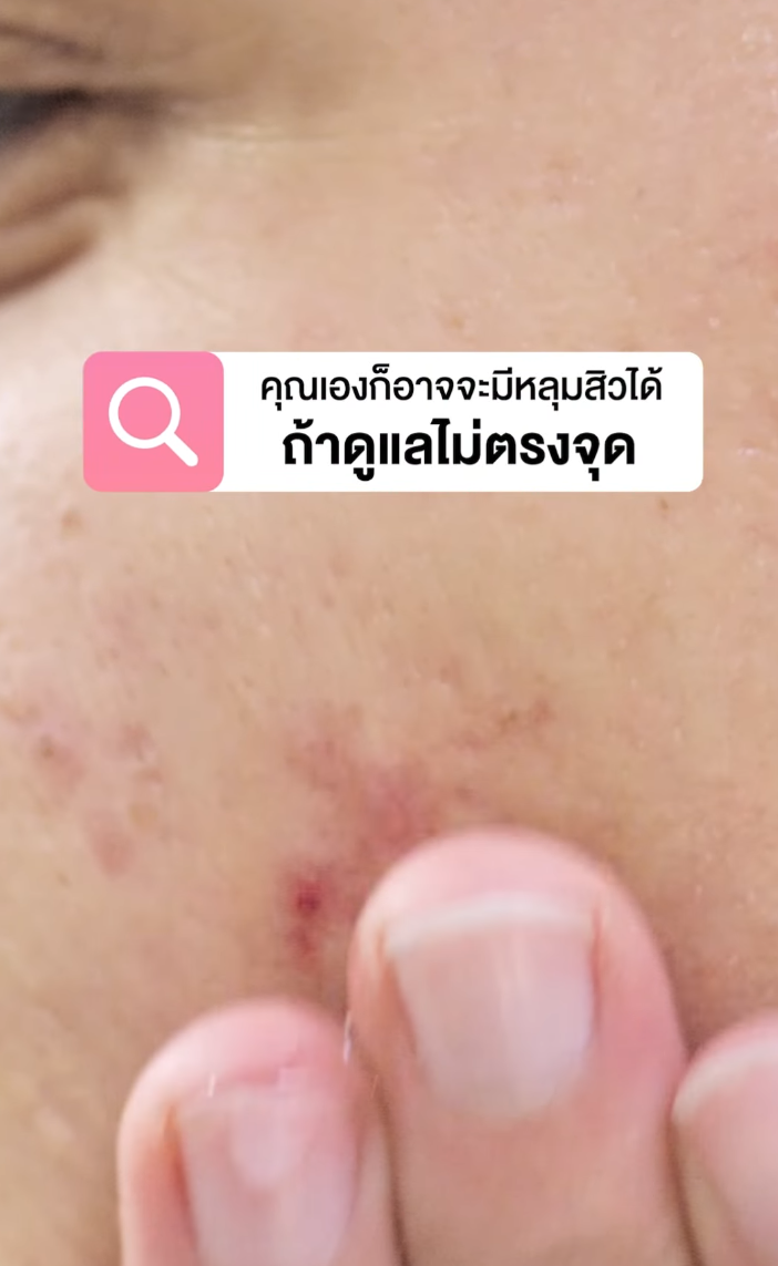 “หลุมสิว” ต้องดูแลก่อนเกิด!
.
ใหม่! Post-Acne Recovery Gel เจลซ่อมรอย จาก Nectapharma
🚨ช่วยให้รอยสิวดูจางลงภายใน 7 วัน และลดโอกาสการเกิดหลุมสิว
🧬 ด้วย 2% Melicica™ สารสกัด Trademark ช่วยดูแลผิวหลังเป็นสิว
☑️ ลดการอักเสบตกค้างใต้ผิว
☑️ ช่วยสร้างเซลล์ผิวใหม่
☑️ ช่วยให้ผิวสมานตัวได้ดีขึ้น
.
🔬 #เจลซ่อมรอย ทดสอบแล้วในคนจริง ว่าช่วยให้รอยสิวดูจางลงใน 7 วัน โดยทุ่มงบวิจัยกว่า 400,000 บาท